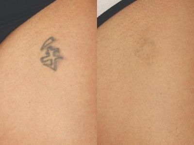 Como eliminar mi tatuaje