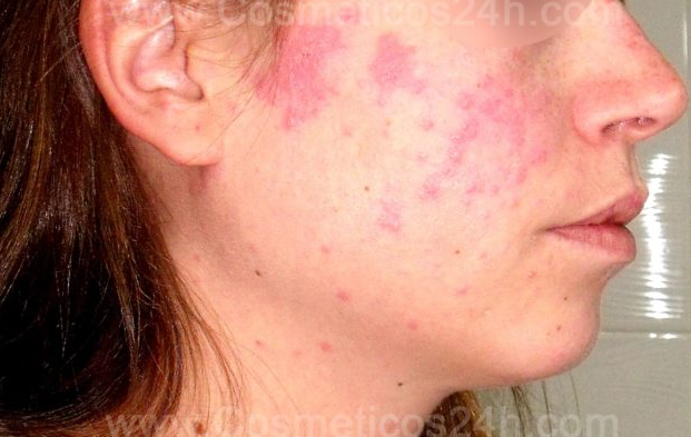Aprender a vivir con Lupus