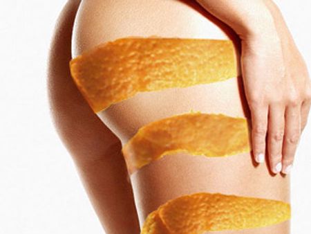 Cremas anticeluliticas: Cuando debo usarlas