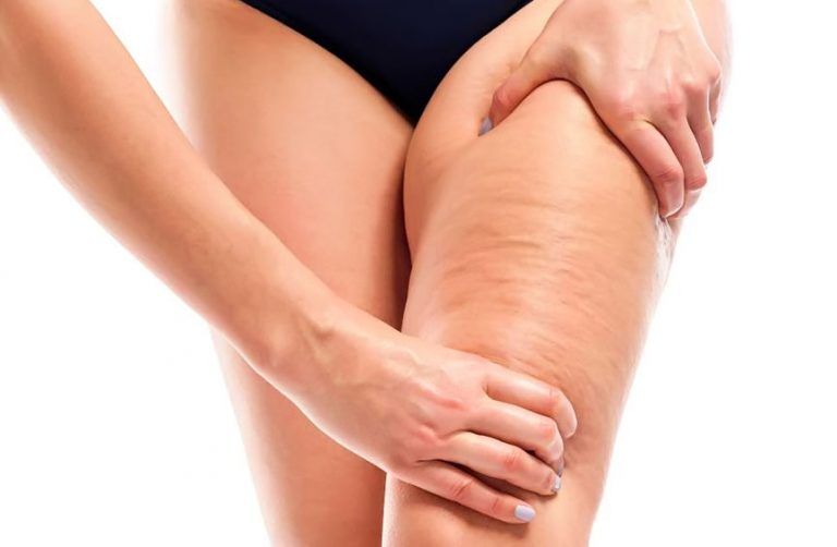 Celulitis: Un problema común