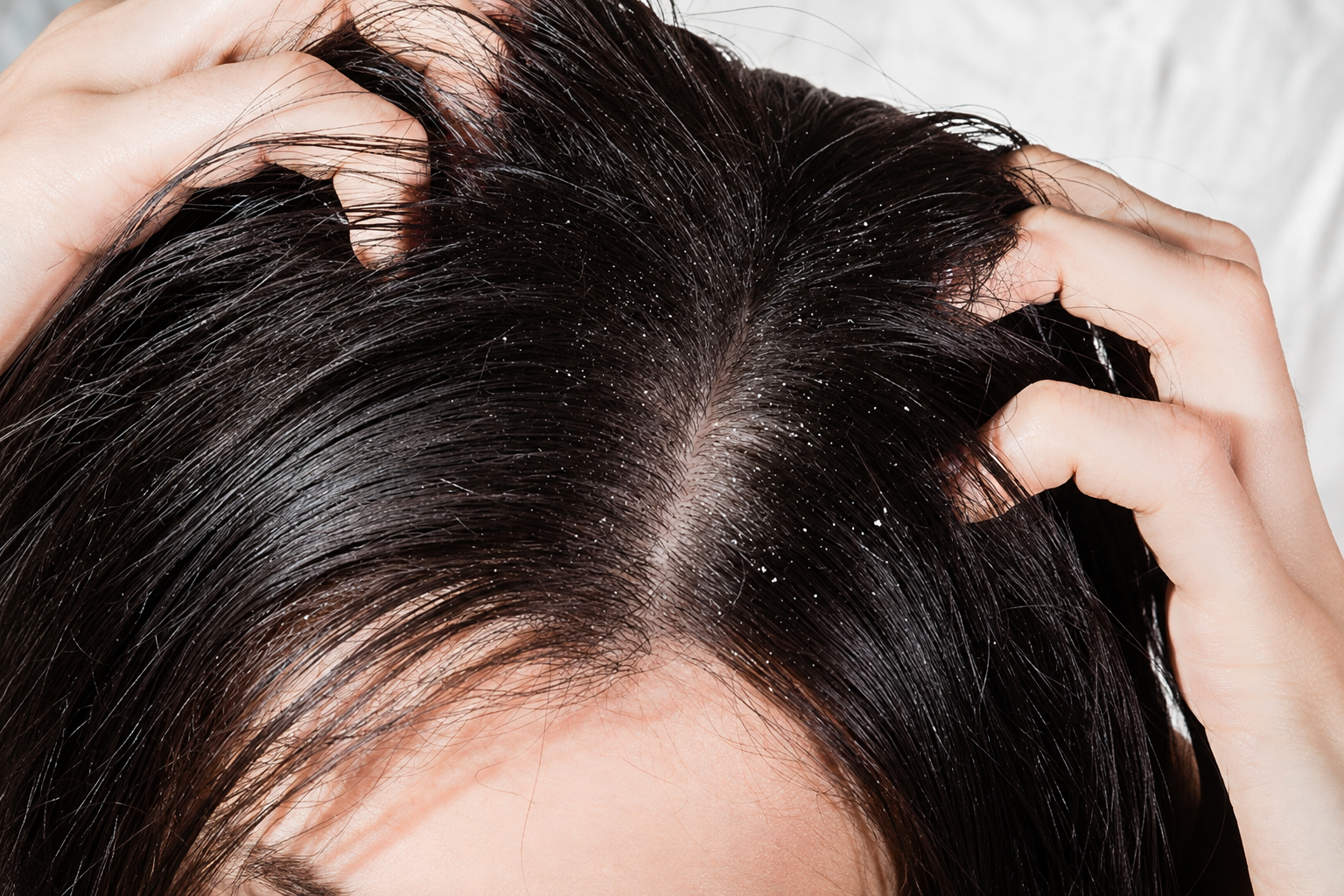 Cabello graso y seborreico