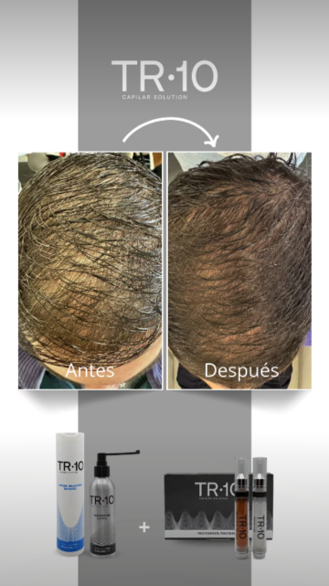 Alopecia androgenica masculina