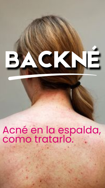 Como eliminar el acné en la espalda 