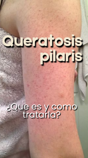 Queratosis pilaris, como tratarla